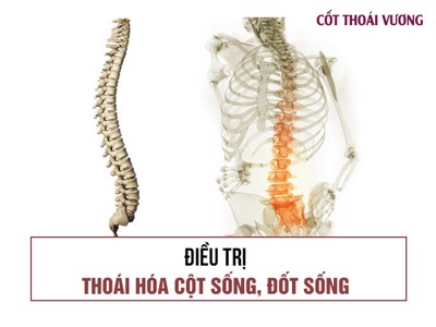 4 Phương Pháp Điều Trị Bệnh Thoái Hóa Cột Sống Hiệu Quả Nhất Hiện Nay